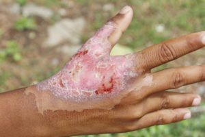 Decatur Burn Injuries Lawyers | Physical Injuries | Ben Crump Decatur Burn Injuries Lawyer