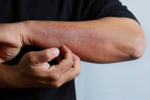 What Causes Skin Infections in Nursing Home Residents?
