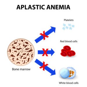 Aplastic Anemia and Other Myelodysplastic Syndromes and Camp Lejeune Contamination