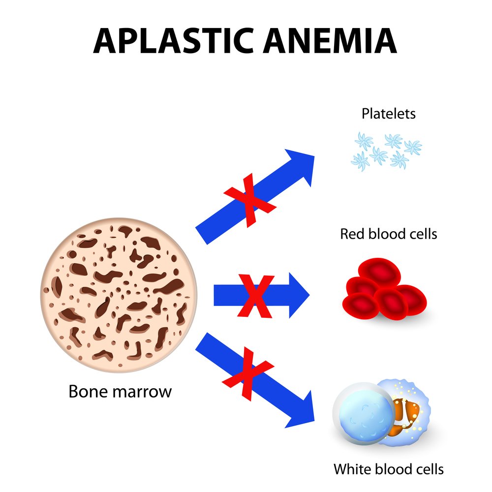 Camp Lejeune: Myelodysplastic Syndromes & Aplastic Anemia