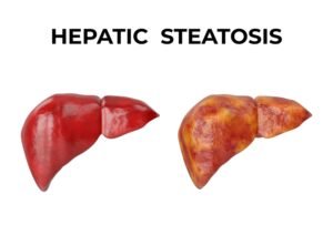 What Causes Hepatic Steatosis?